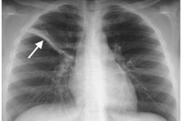 Rốn phổi tăng đậm là bệnh gì